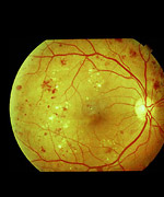 What is Diabetic Retinopathy? 
