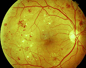 What is Diabetic Retinopathy