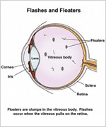 Flashers and Floaters